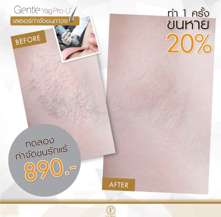 F Clinic จัดโปรทดลองทำเลเซอร์