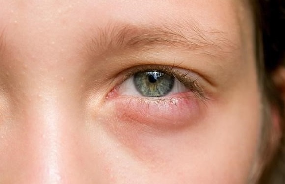 สาเหตุ ป้องกัน รักษา ปวดตาข้างเดียว - phuyings