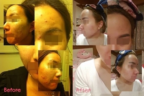 รักษาสิวด้วยตัวเอง